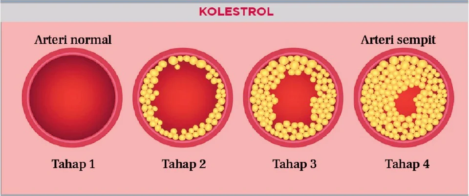 bacaan kolestrol normal