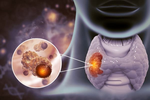 10 tanda thyroid