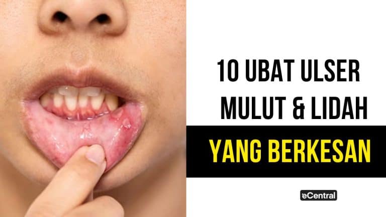 Ubat ulser mulut