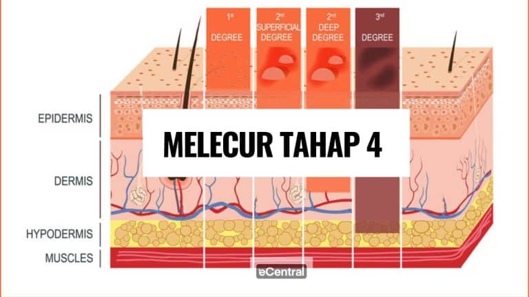 Melecur tahap 4