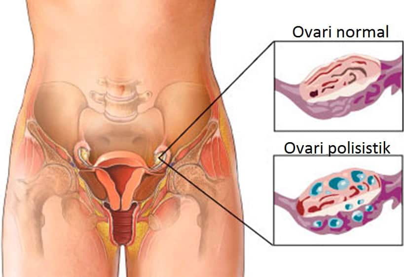 pcos maksud